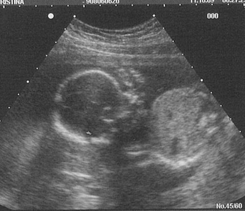 the week 20 ultrasound